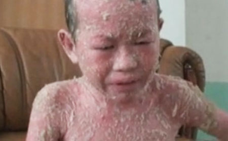 儿童患牛皮癣全身皮损严重如何治疗