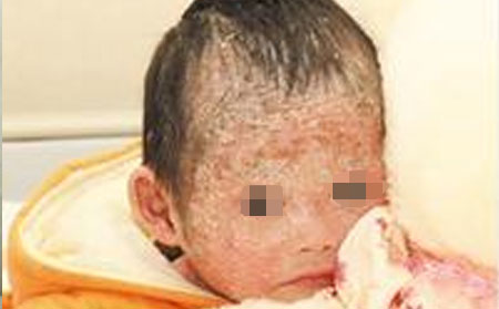 儿童头部皮损严重的牛皮癣治疗