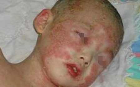 儿童皮损严重的牛皮癣患者治疗