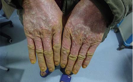 手部皮损严重的老年牛皮癣患者治疗