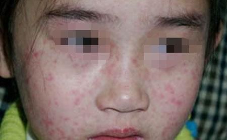 儿童面部红色疱疹治疗